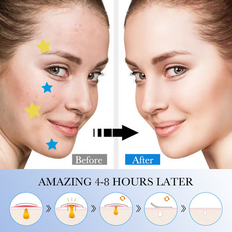 Acne Sticker, Colored Acne Sticker, Student Acne Sticker,  Wholesale