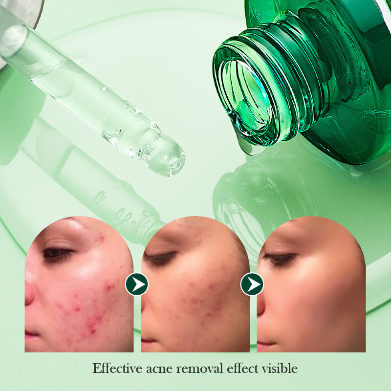 Acne Serum Acne Mark Skin Care Products Hydrating Facial Anti-Acne Serum
