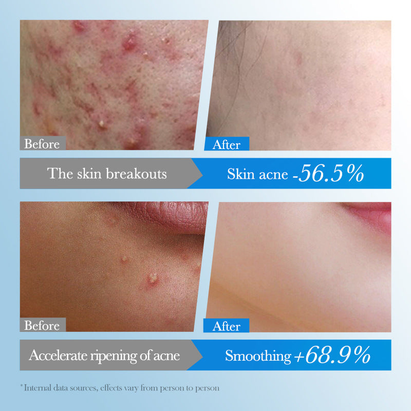 Acne Sticker, Colored Acne Sticker, Student Acne Sticker,  Wholesale